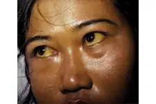 Sarılık Belirtileri ve Tedavisi